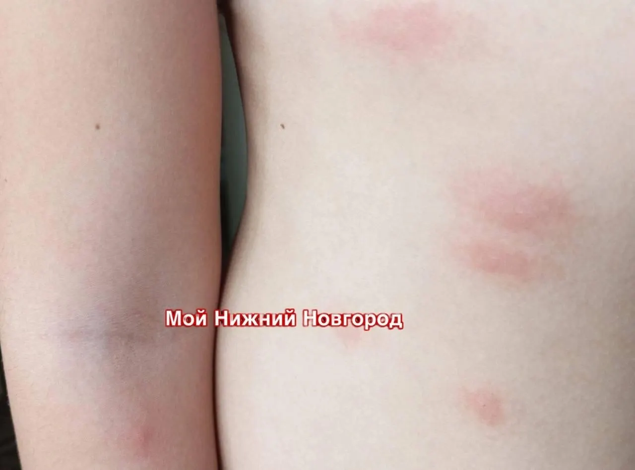 Нижегородцы жалуются на&nbsp;зуд&nbsp;и&nbsp;сыпь после&nbsp;купания в&nbsp;Светлоярском озере