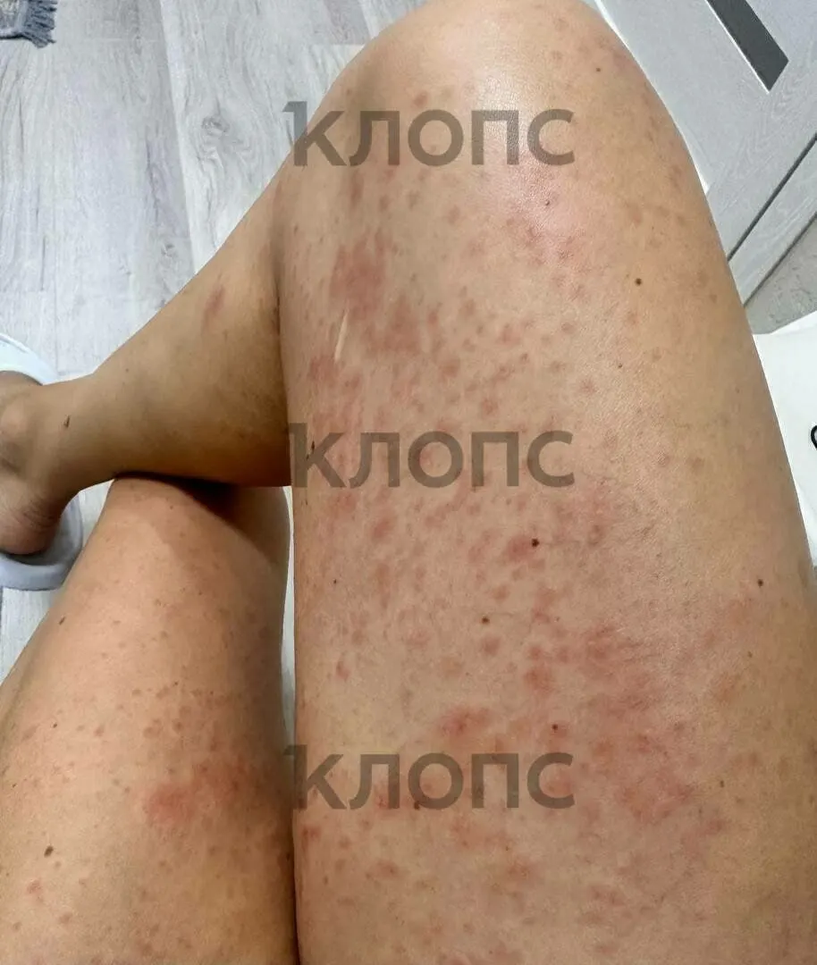 Гусеницы походного шелкопряда на Куршской косе могут вызвать аллергию: местная жительница и её сын столкнулись с кожной реакцией после поездки.
